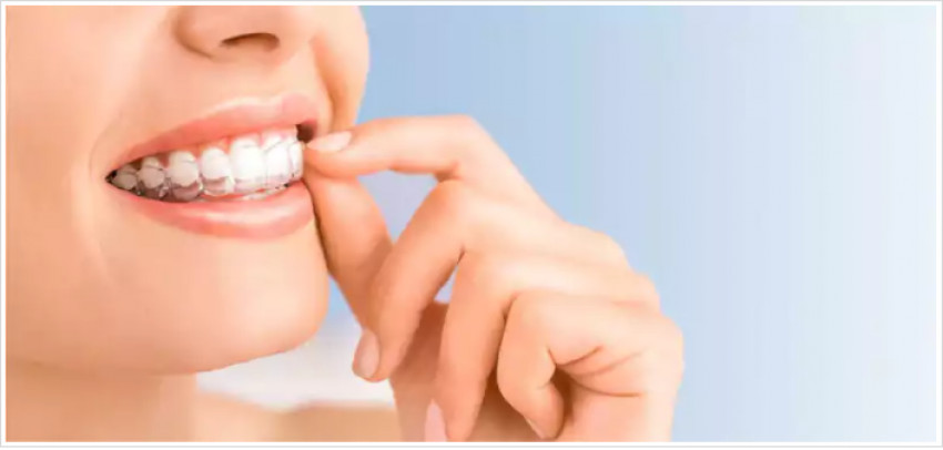 How Is Getting Transparent Teeth Braces In Mumbai More Than Just Getting Straight Teeth?