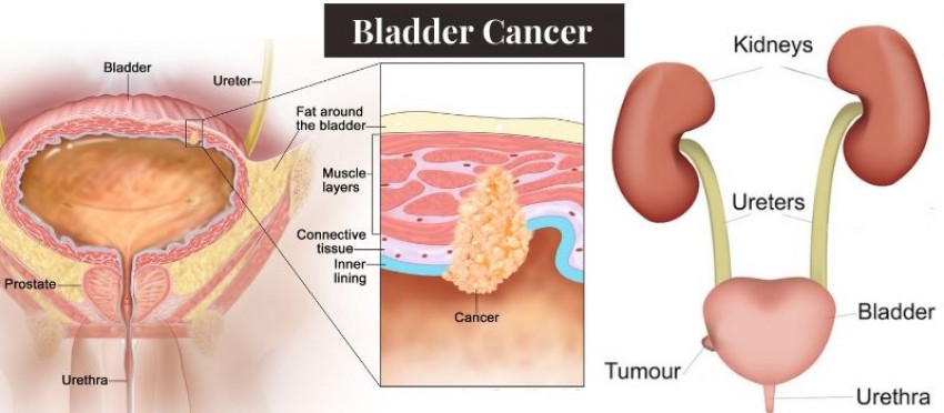 What is a Trans Urethral Resection of a Bladder Tumor (TURBT)?