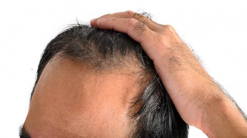 Types of Alopecia: An Overview