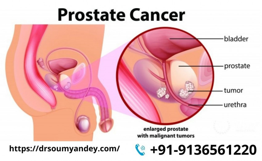 Know more about Enlarged Prostate by Dr.Soumyan Dey