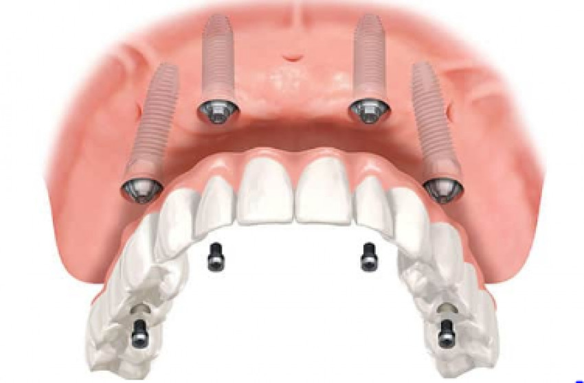 Bridging the gap with dental implants