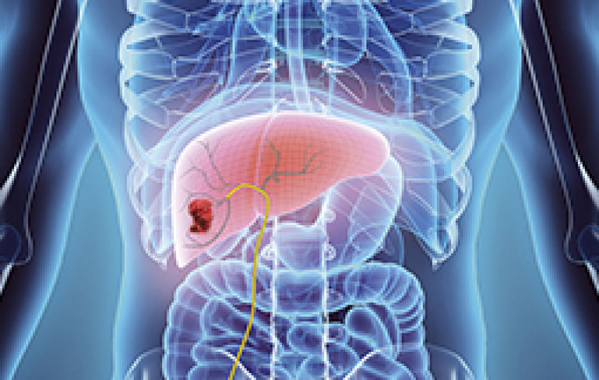 Liver cancer treatment in India