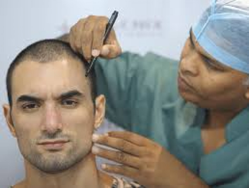 Is Hair Transplant Surgery in India Effective and Safe