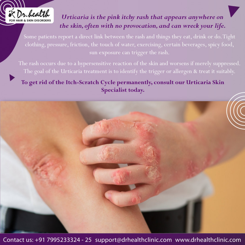 How to Be Kind to Yourself When You Have Psoriasis? Find the Right Treatment for Psoriasis