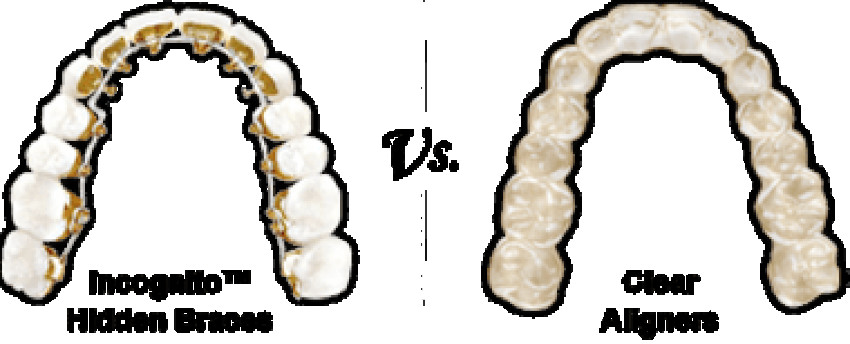 About Orthodontist Dubai Incognito Braces