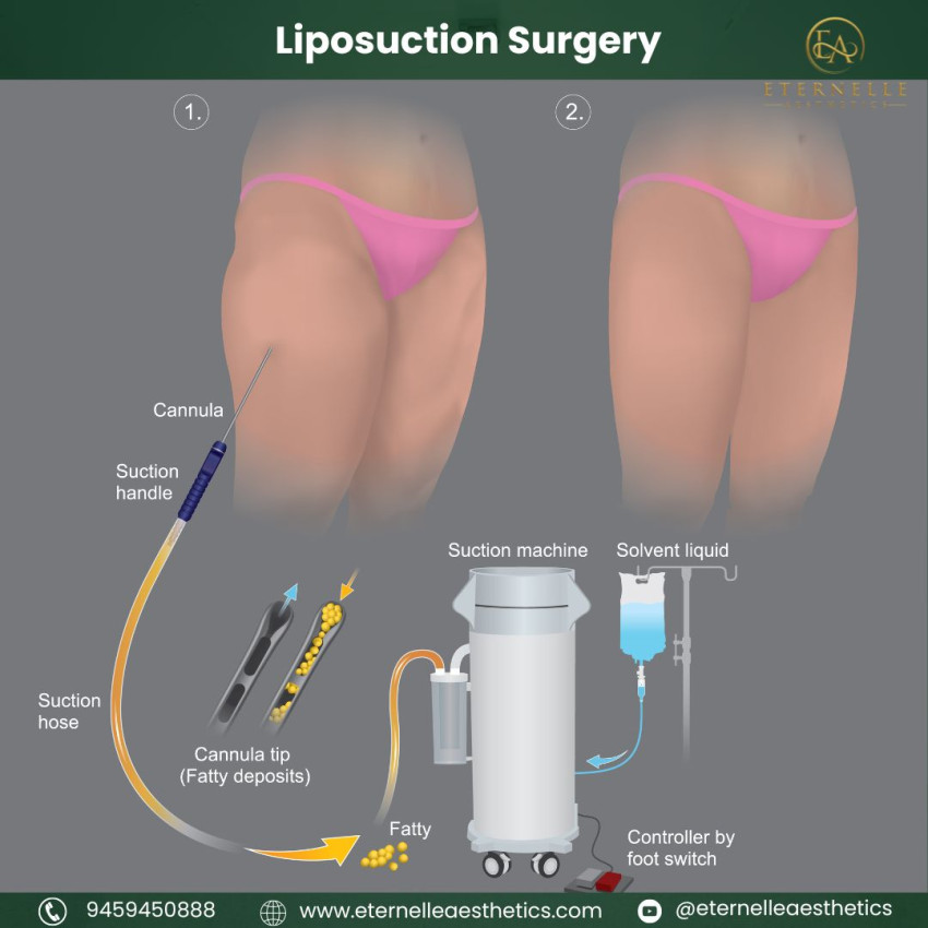 Types of Liposuction Surgeries | Benefits of a Liposuction.  Eternelle Aesthetics