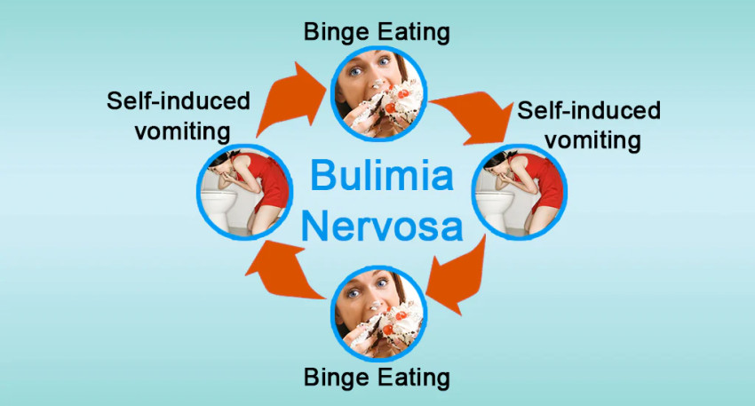 Bulimia Nervosa Market Report: Epidemiology, Trends and Forecast to (2023-2033)