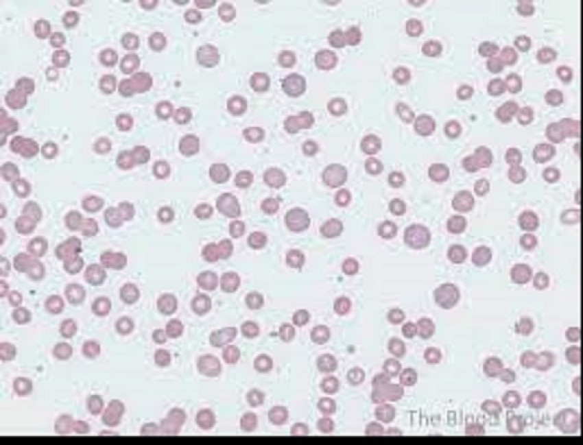Warm Autoimmune Hemolytic Anemia (WAIHA) Market Size 2023-2023