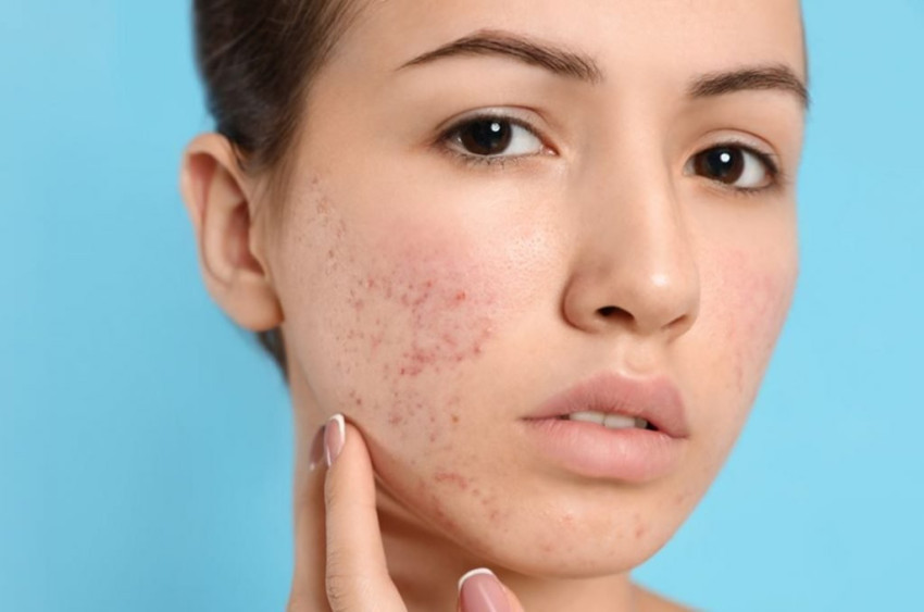 Banishing Blemishes: Comprehensive Approaches to Addressing Acne Scars