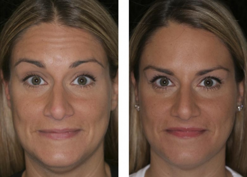 Where Can You Receive Expert Dysport Injections In Torrance, CA?