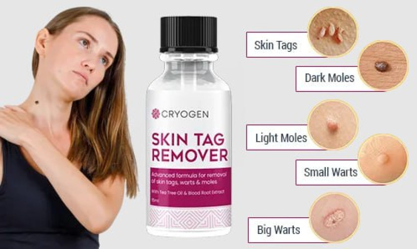 Cryogen Skin Tag Remover Reviews