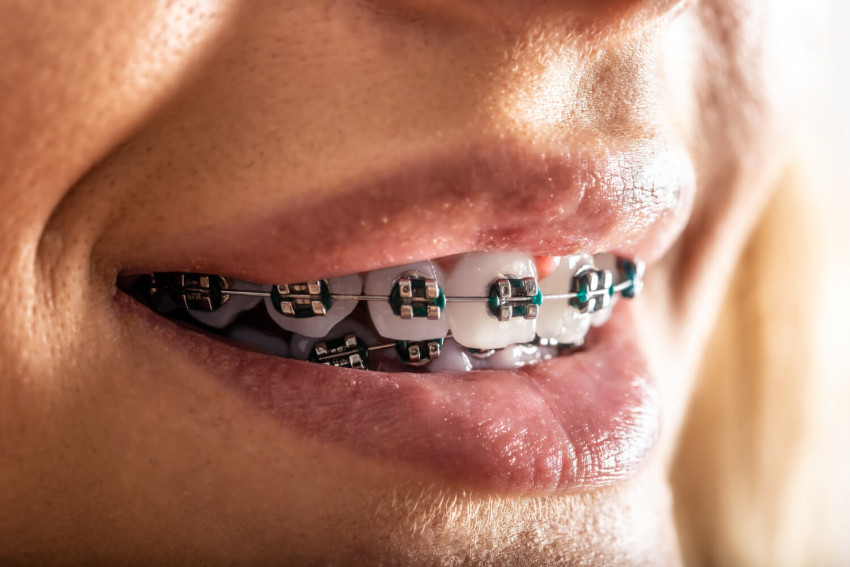 Braces vs. Invisalign: Deciding the Best Option for Teeth Straightening