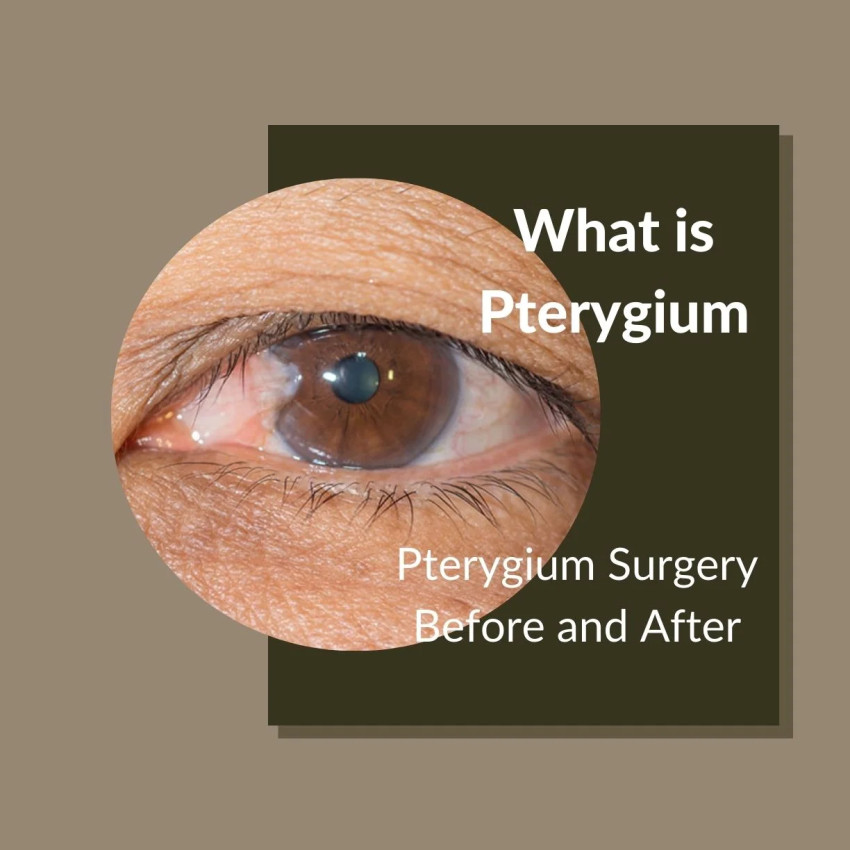 Pterygium Surgery Before and After