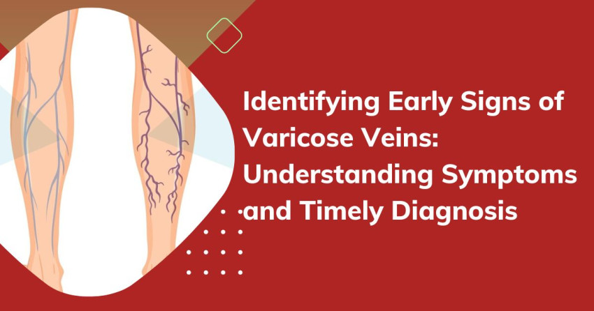 Early Signs and Symptoms of Varicose Veins