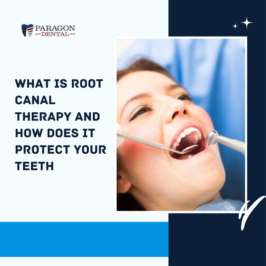 What Is Root Canal Therapy and How Does It Protect Your Teeth