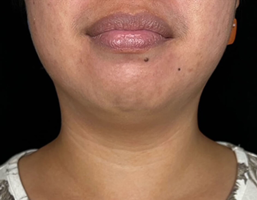 Targeted Exercises for Strengthening Neck Muscles and Reducing Double Chin Appearance