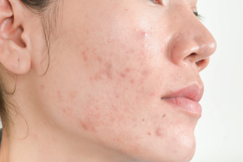 The Science Behind Acne Scars Treatment in Dubai