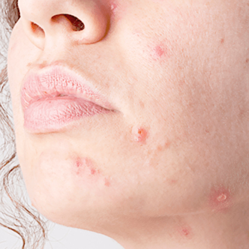 Non-Surgical Actinic Keratosis Treatments in Dubai