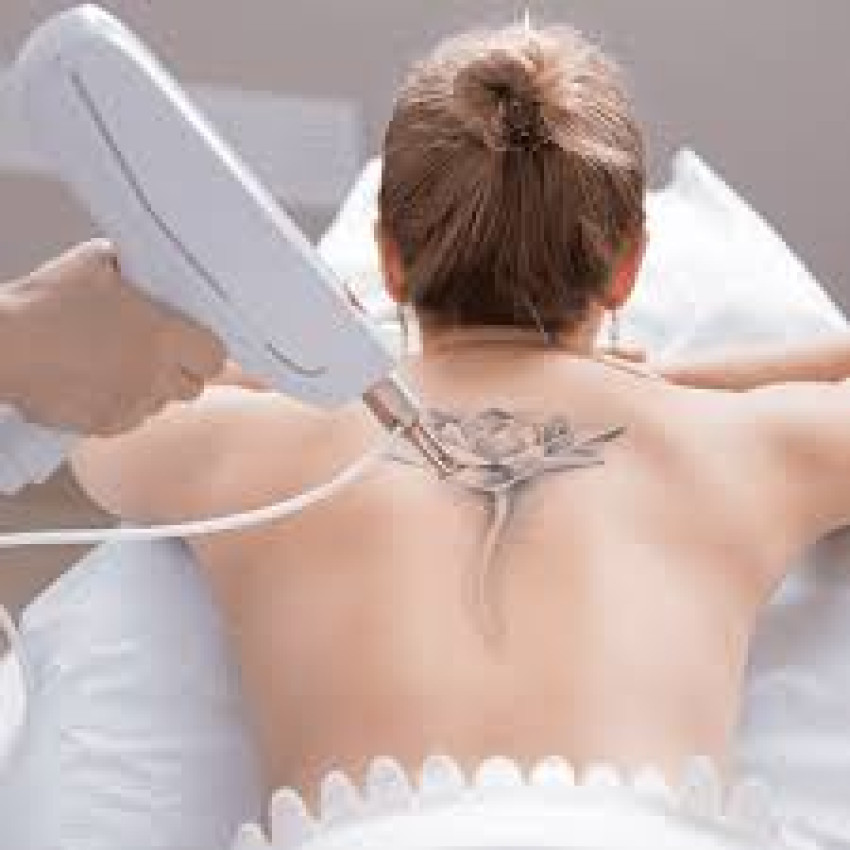 Find out about the most recent clinical procedures for tattoo expulsion in Dubai