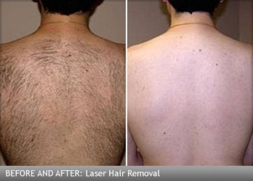 Laser Hair Removal Dubai: Best Clinics & Cost Breakdown