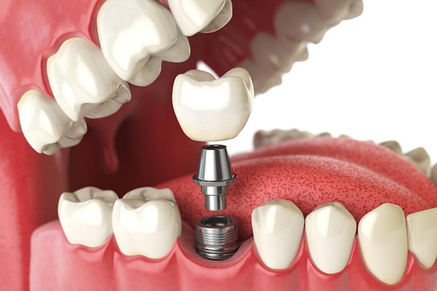Are dental implants good or bad?