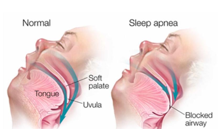Snoring Surgery in Delhi: Is It the Best Snoring Treatment for You