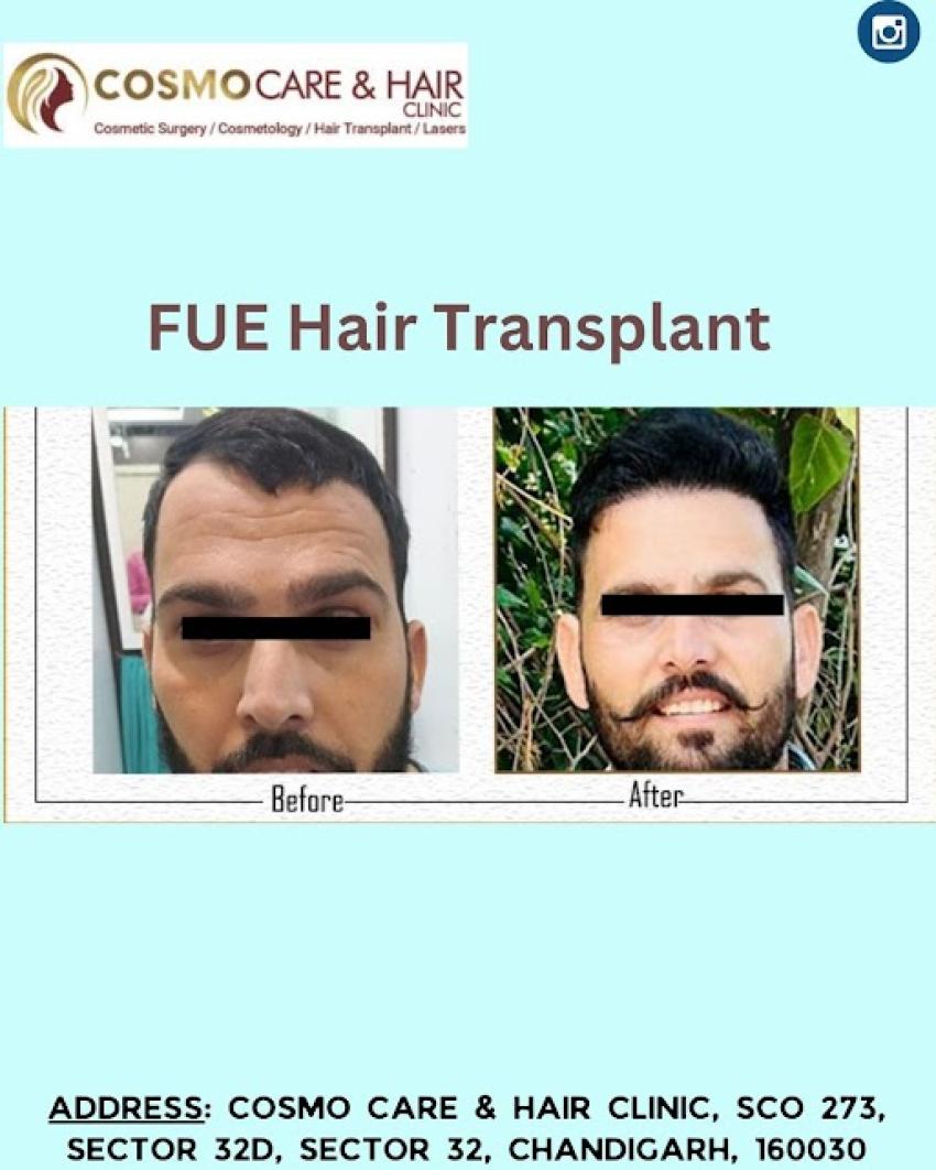 Why Choose Chandigarh for Your Hair Transplant Surgery?
