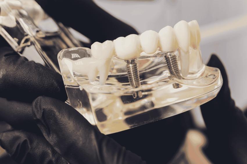 Are Dental Implants safe for diabetic patients? Here’s what you need to know