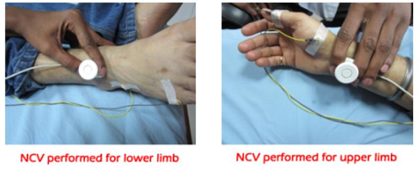 Diabetic? Don’t Ignore Numbness — Get a Nerve Conduction Test Near You
