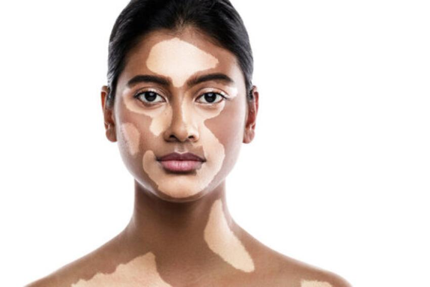 How to Help Someone Close Living with Vitiligo