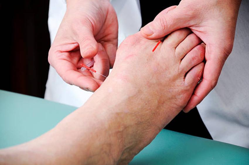 How Acupuncture Provides Natural Relief for Migraines and Headaches?