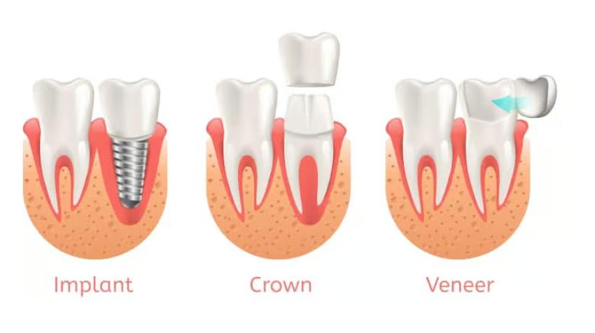 Want to Have a Perfect Smile? Find Same Day Crown Las Vegas