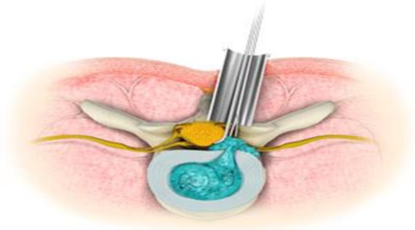 How Minimal Access Spine Surgery in Kolkata Can Improve Spinal Health