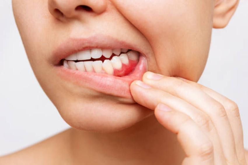 5 Reasons Why Bleeding Gums Are Not Normal!