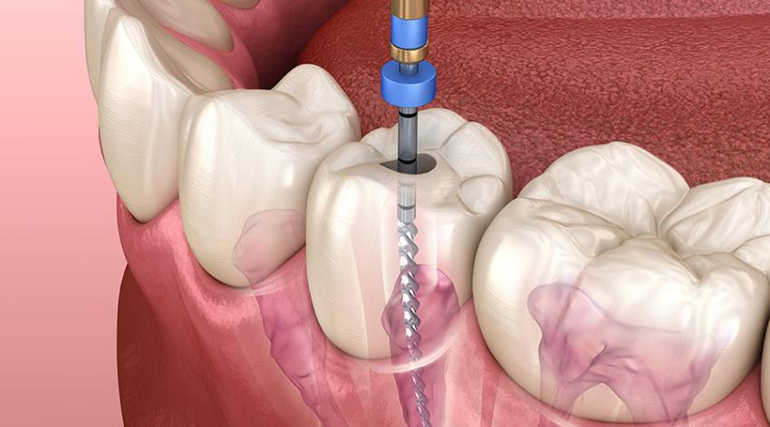 Best Dentist For Root Vanal Treatment In Paschim Vihar: The Bottom Line