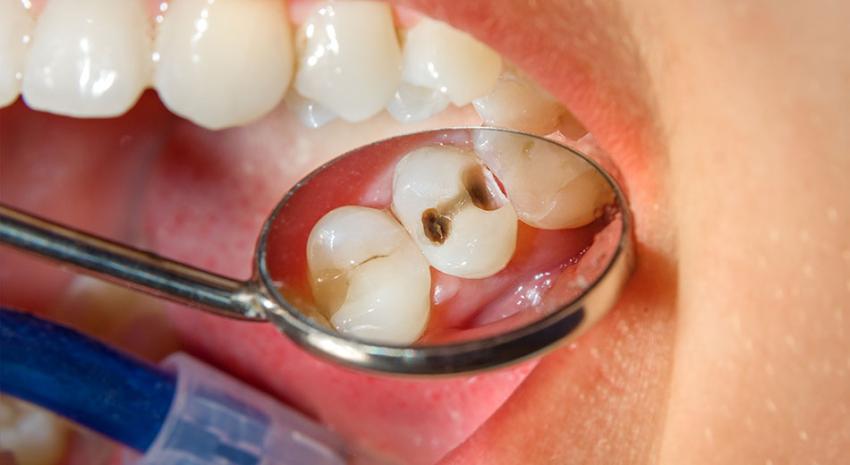 Six Interesting Facts and Myths about Tooth Cavities