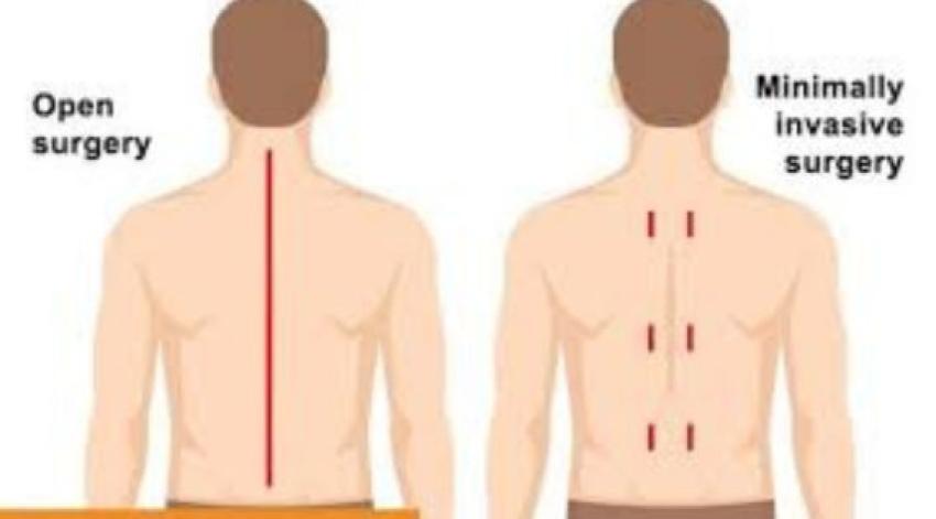 Minimally Invasive Spine Surgery Vs Traditional Open Surgery