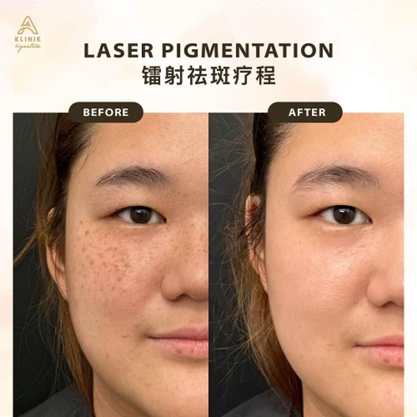 Where Can You Get Affordable Skin Booster Treatment in Malaysia?