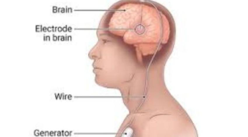 The Science Behind the Brain Pacemaker: Understanding Deep Brain Stimulation