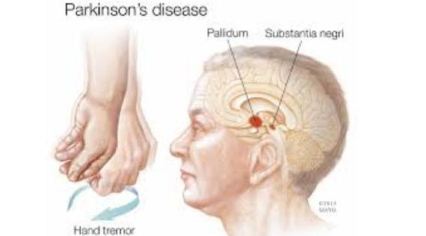 Parkinson’s Disease Treatment in Kolkata: DBS Surgery Offers New Hope