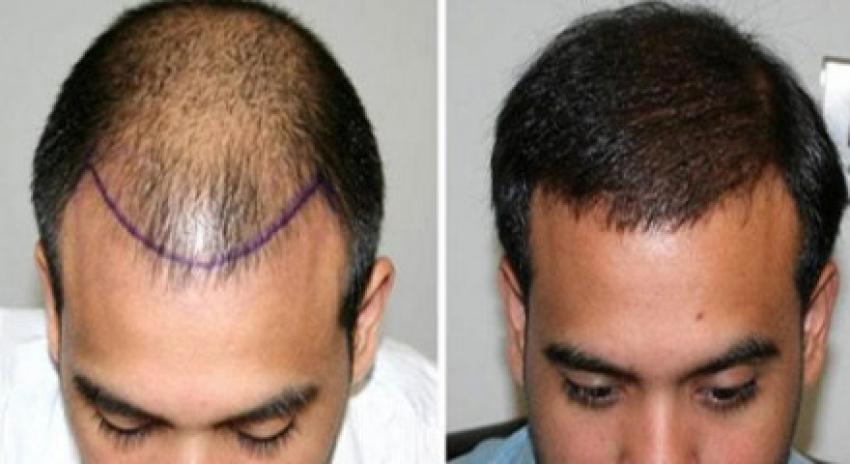 زراعة الشعر في الرياض دون ألم: حقيقة أم مبالغة؟