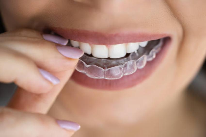 A Modern Smile Transformation with Clear Aligners in Glendale