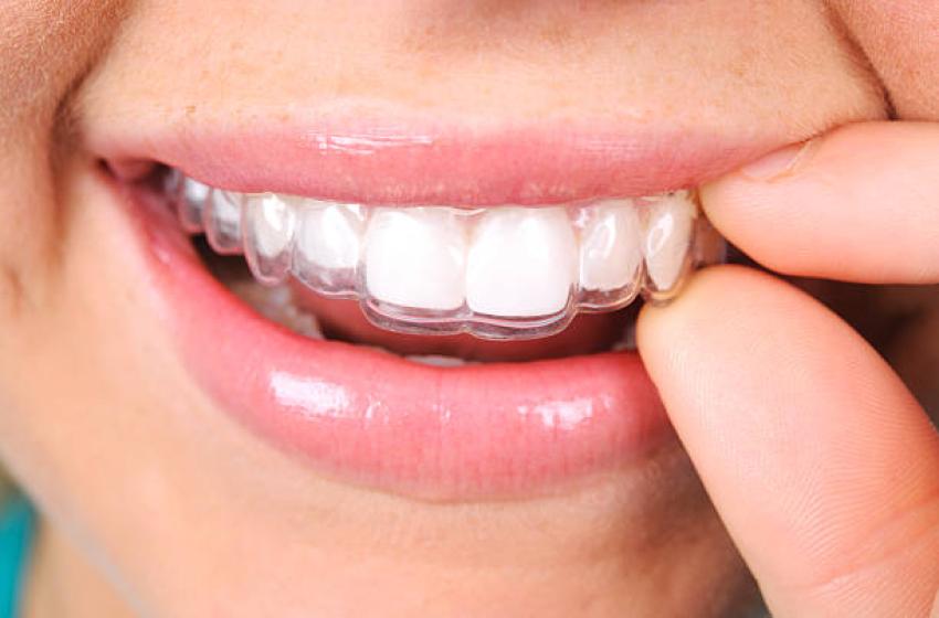 The Rise of Clear Aligners for Comfortable Smiles in Porter Ranch CA