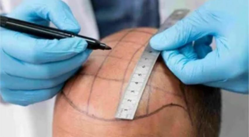 ROI of Self-Image: Why a Hair Transplant in Riyadh is a Strategic Career Move