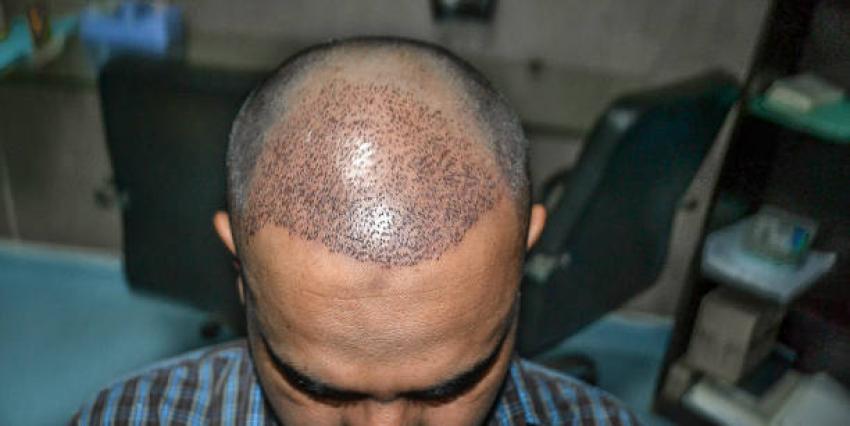 زراعة الشعر في دبي: جودة عالمية وأسعار تنافسية