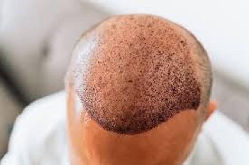 قبل وبعد: تحولات مذهلة لزراعة الشعر في دبي