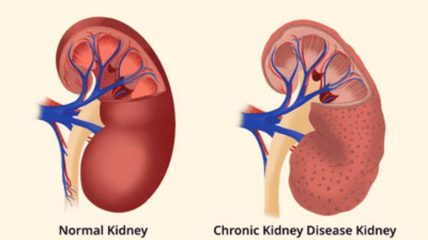 Kidney Failure vs Chronic Kidney Disease: What’s the Difference?