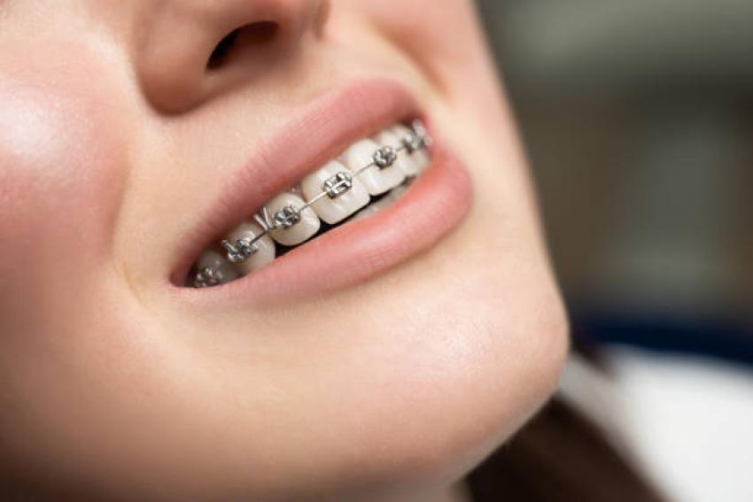 Achieving a Well-aligned smile with professional braces care
