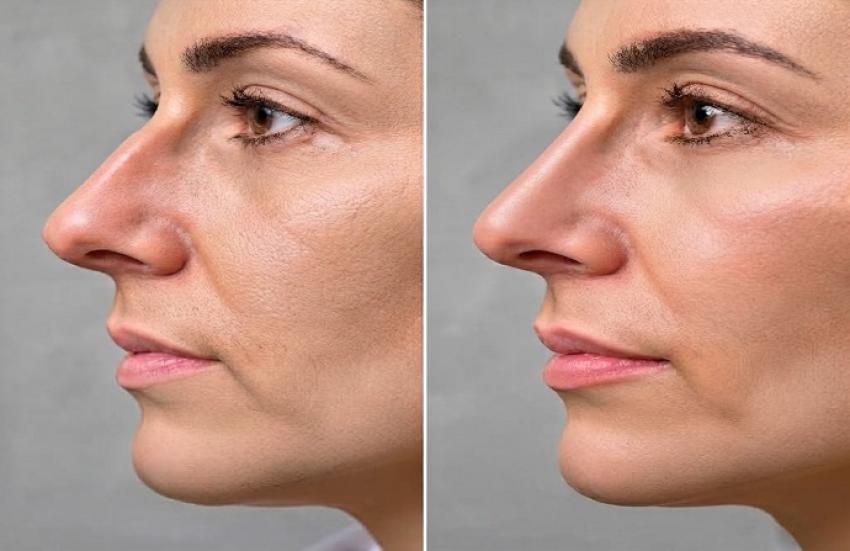 Rhinoplasty in Dubai: Risks and How They Are Managed