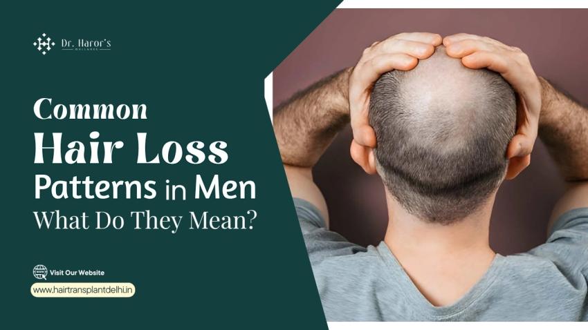 Common Hair Loss Patterns in Men: What Do They Mean?